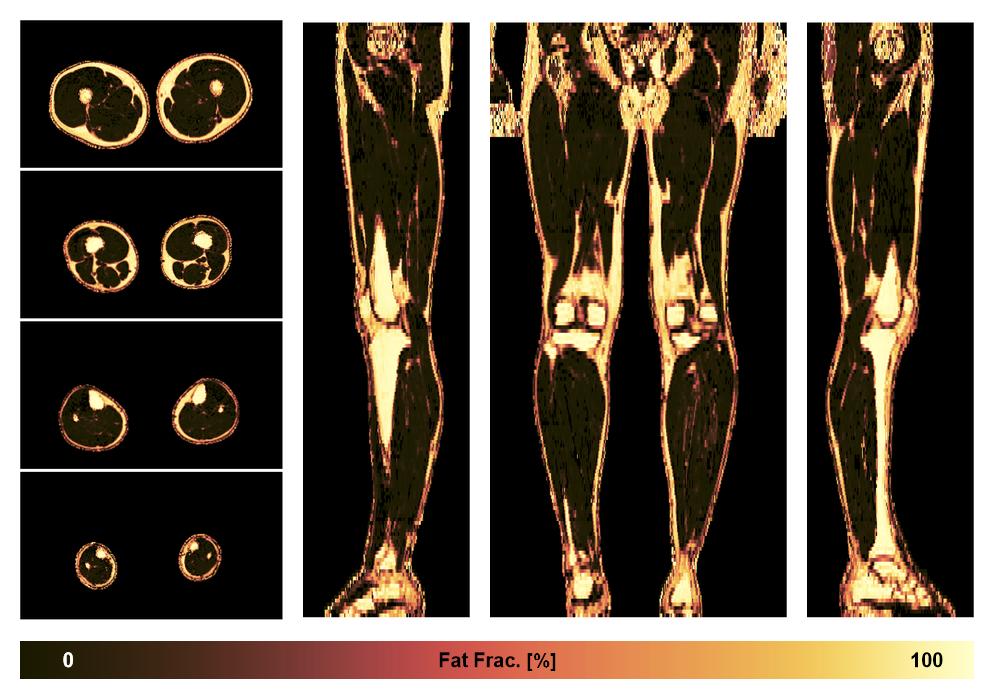 The fat fraction of the lower extremity obtained from the dixon reconstruction for muscle water fat quantification.